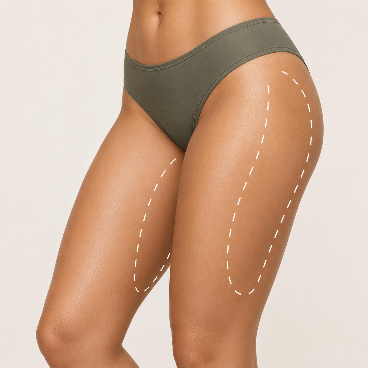 EMShape thighs treatment area