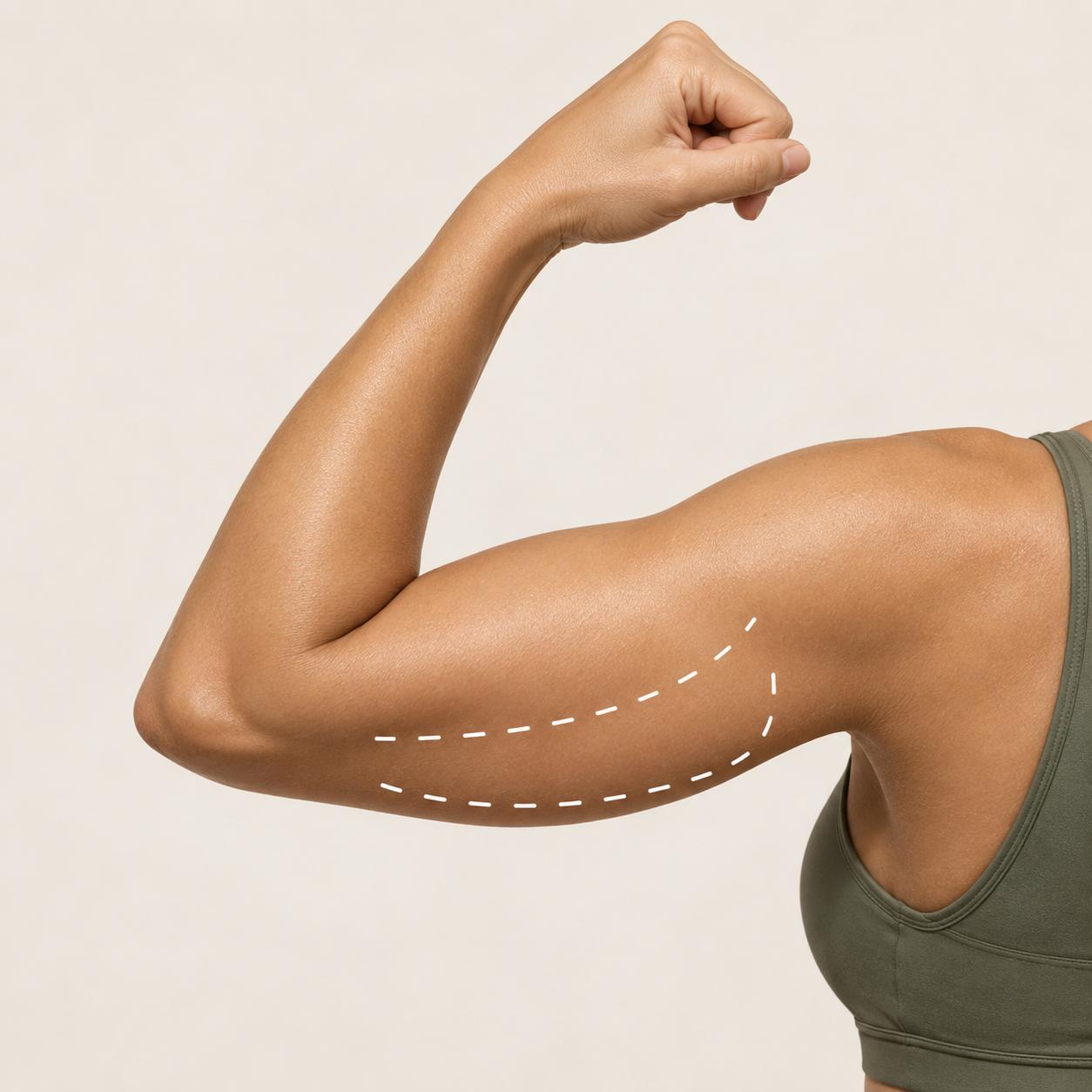 EMShape arms treatment area
